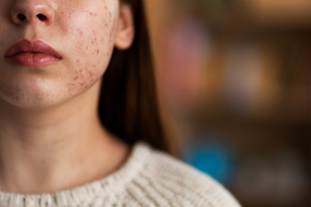 visage de femme touché par l'acné