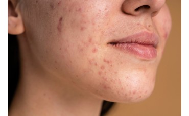 3 huiles végétales pour la peau acnéique