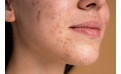 3 huiles végétales pour la peau acnéique