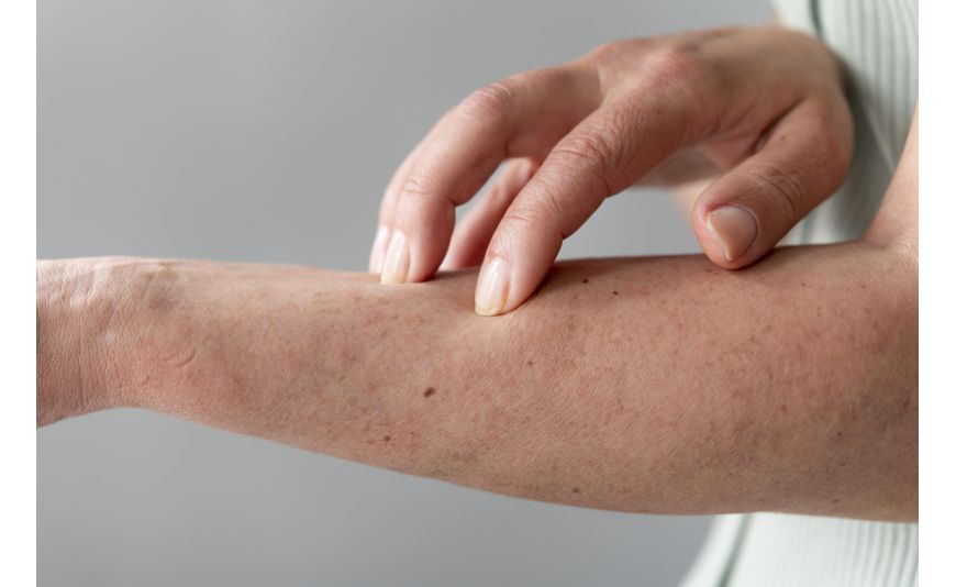 Nos conseils pour soulager l’eczéma de façon naturelle