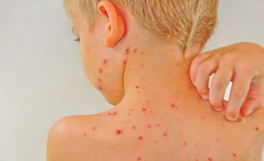 Soulager les démangeaisons de varicelle naturellement